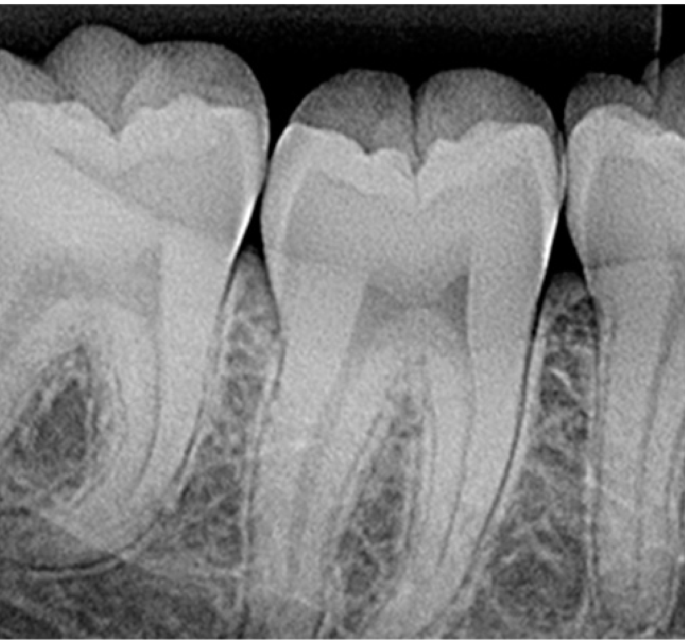 PERIAPICAL